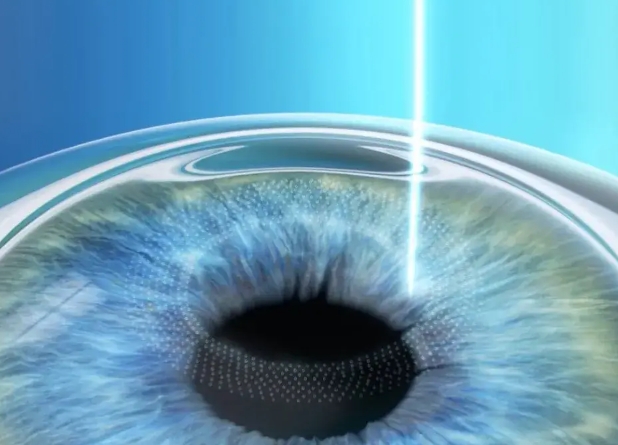 激光近视眼手术大概多少钱？